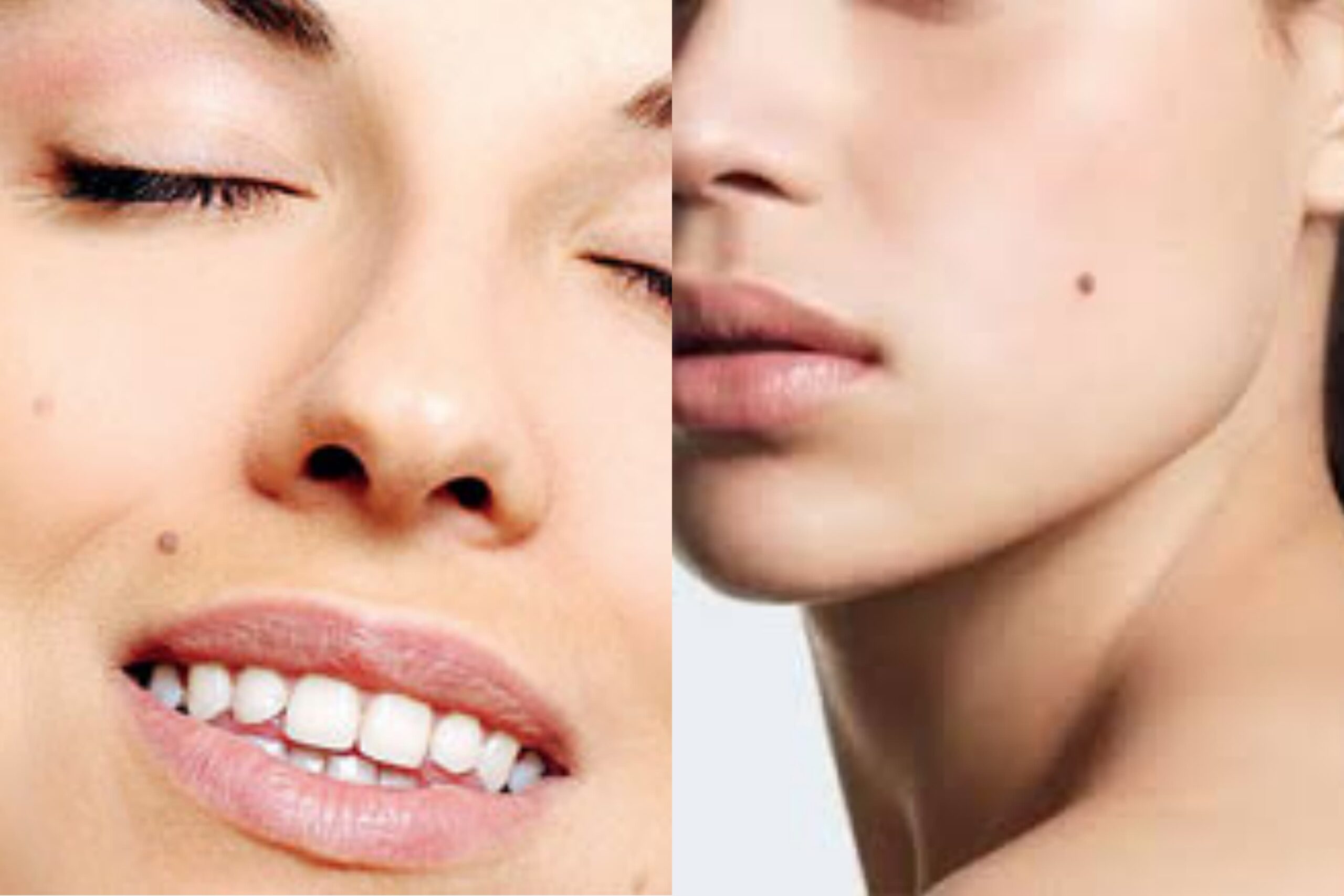 ඔබේ උපන් ලපය බිහිසුනු රෝගයක මූලාරම්භයද කියලා හරියටම දැනගමුද ?