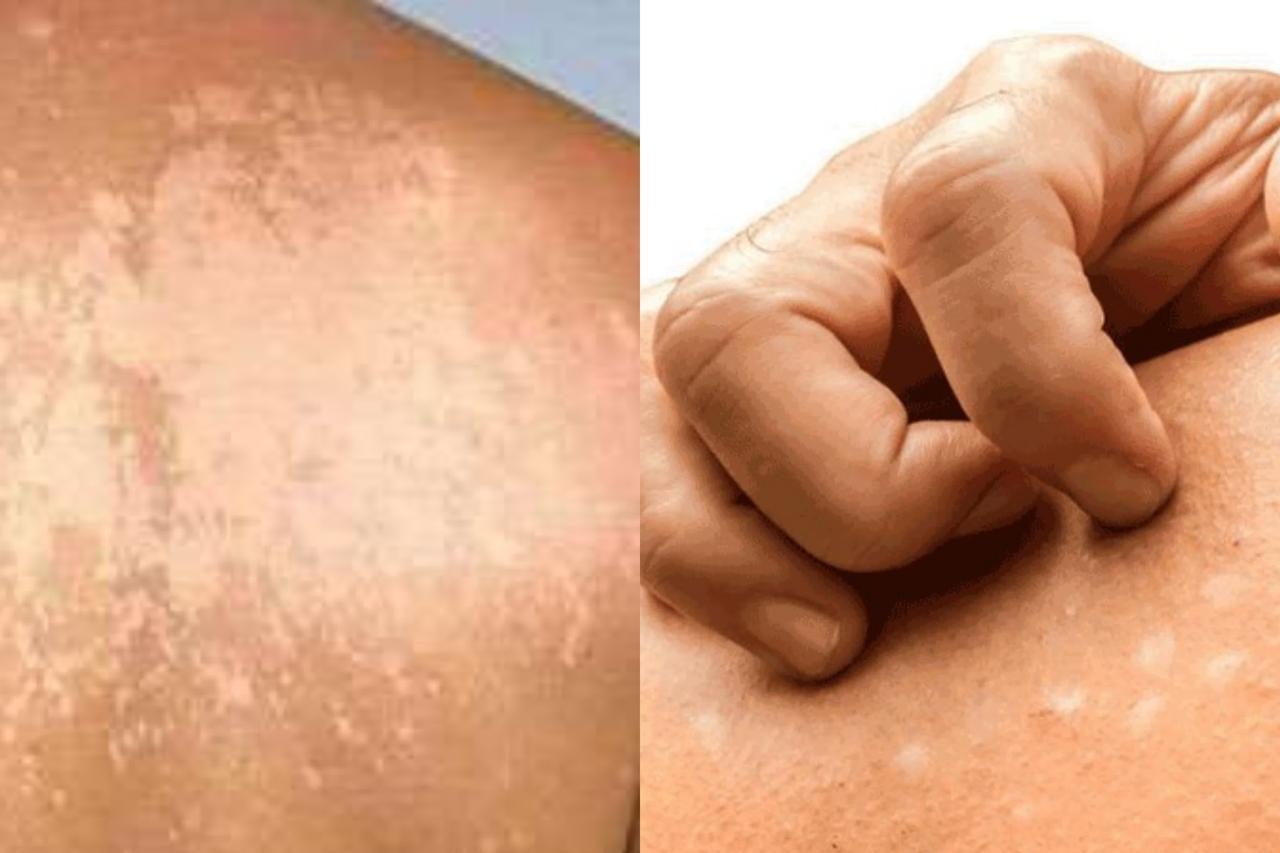 ඔබත් අළුහම් නිසා පීඩා විඳිනවා නම් මෙන්න සුව කරගන්න හොඳම ක්රමය…